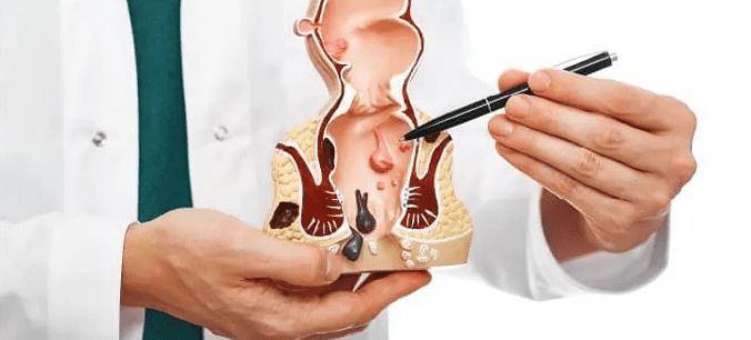 Anal Fissure Treatment