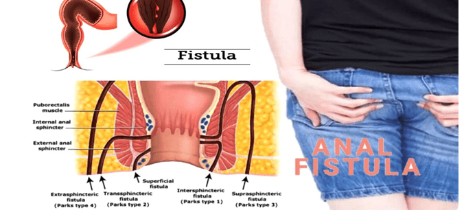 Anal Fistula Prevention