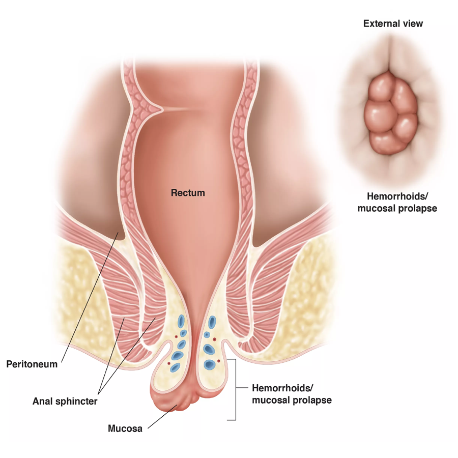 Hemorrhoids & Piles Treatment at LaserQure in Hyderabad Hemorrhoids & Piles Treatment at LaserQure in Hyderabad