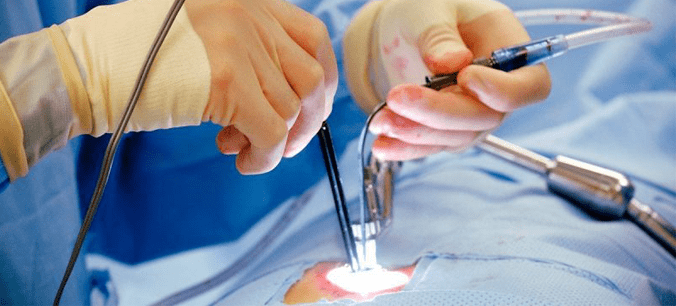 Pilonidal Sinus Treatment at laserqure