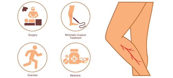 Preventing Varicose Veins in east steps