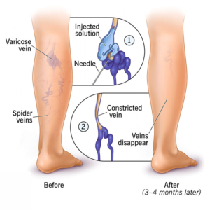 Varicose veins treatment at laserqure Varicose veins treatment at laserqure
