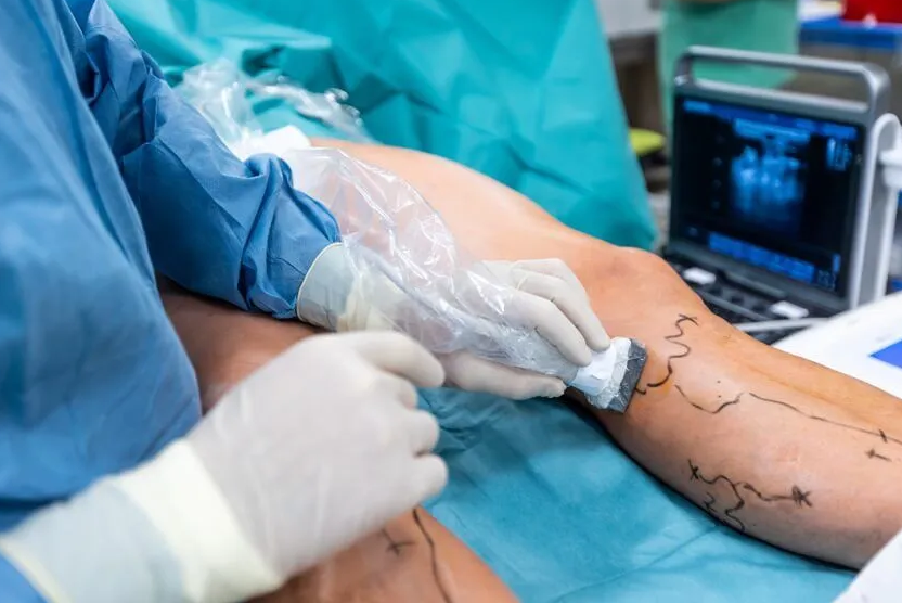 Varicose veins Treatment at Laserqure in Hyderabad Varicose veins Treatment at Laserqure in Hyderabad