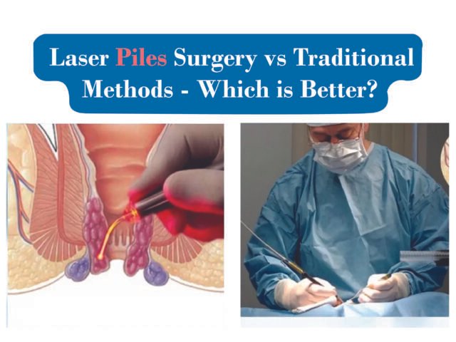 Laser vs Traditional Piles Treatment, Which is the Best?