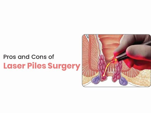 Pros and Cons of Laser Piles Surgery