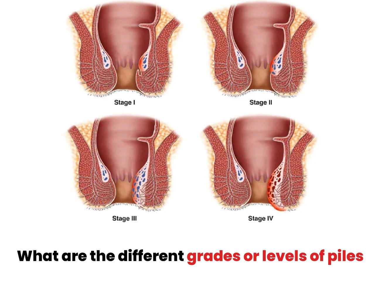 What are the Different Grades or Levels of Piles