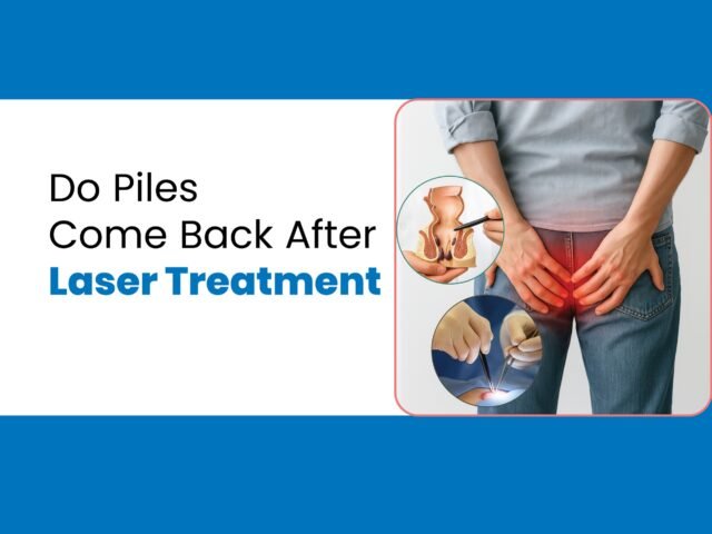 Do Piles Come Back After Laser Treatment