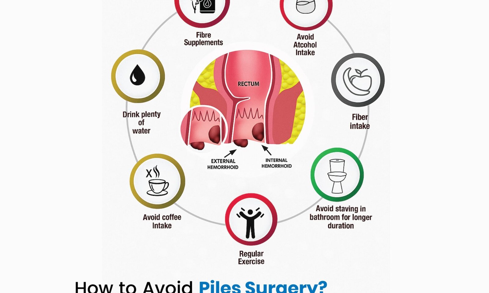 How to Avoid Piles Surgery?