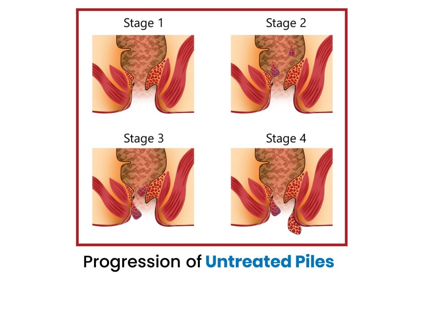 Non Inflamed Pile Progression of Untreated Piles - LaserQure