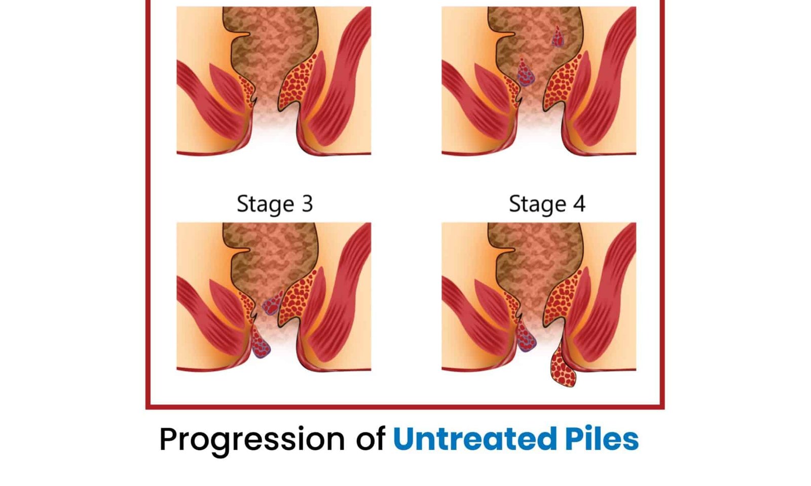 Progression of Untreated Piles