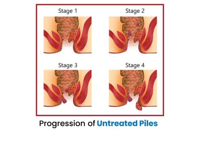 Progression of Untreated Piles