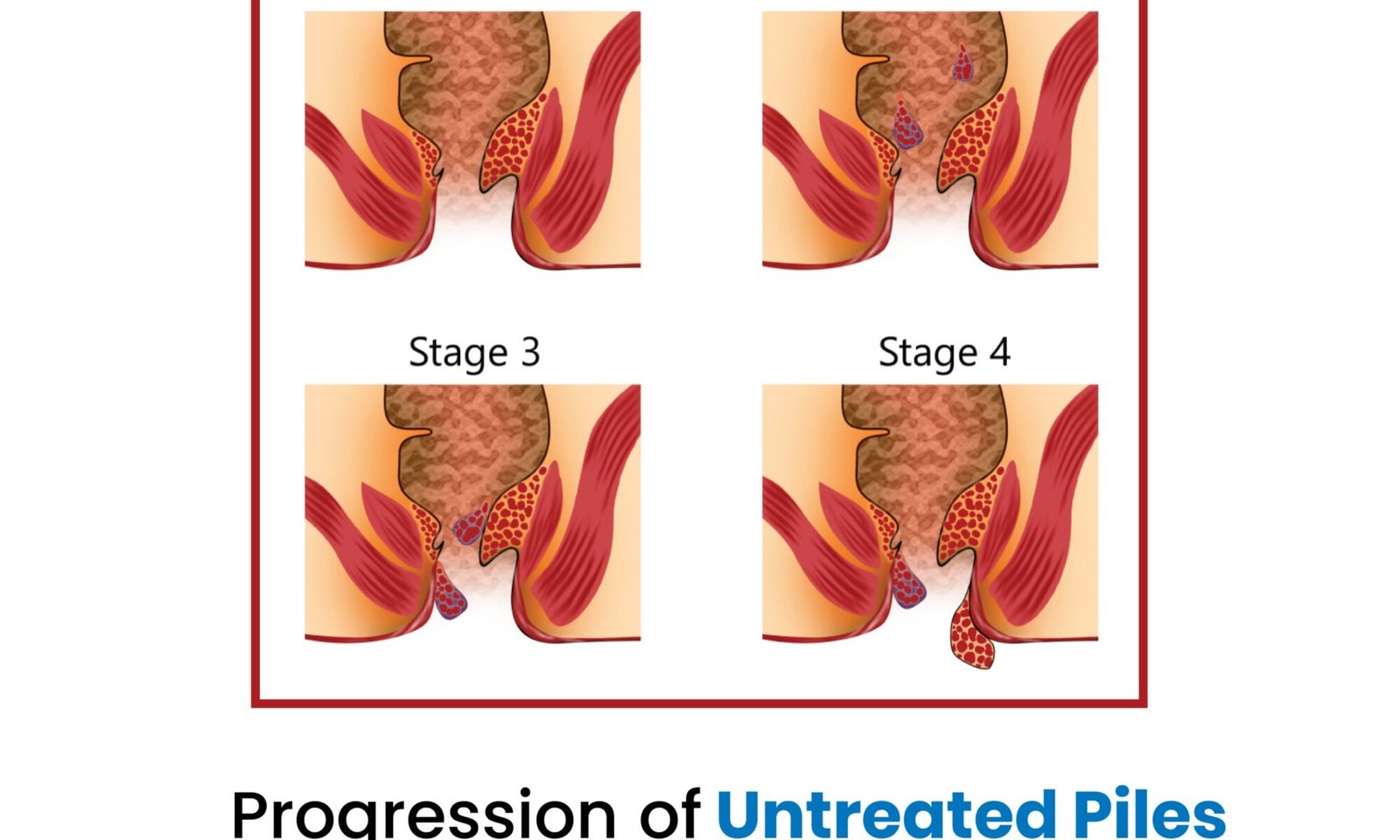 Progression of Untreated Piles