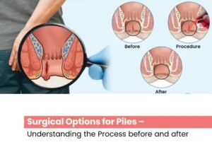 Surgical Options for Piles