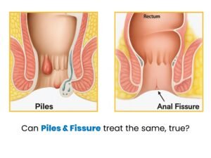 Can Piles & Fissure treat the same