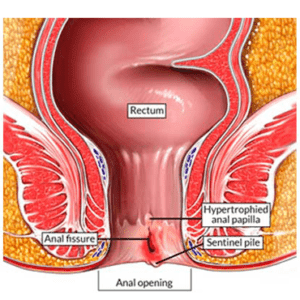 anal-fissure-service-300x300