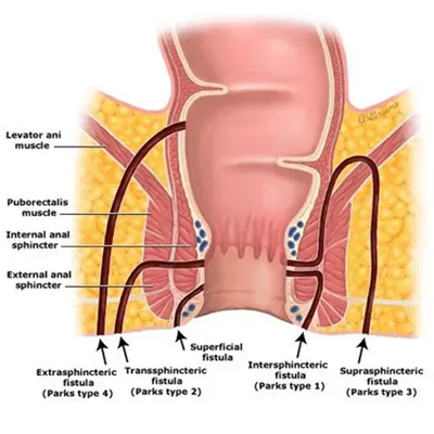 anal-fistula-service-1