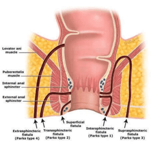 anal-fistula-services-300x300