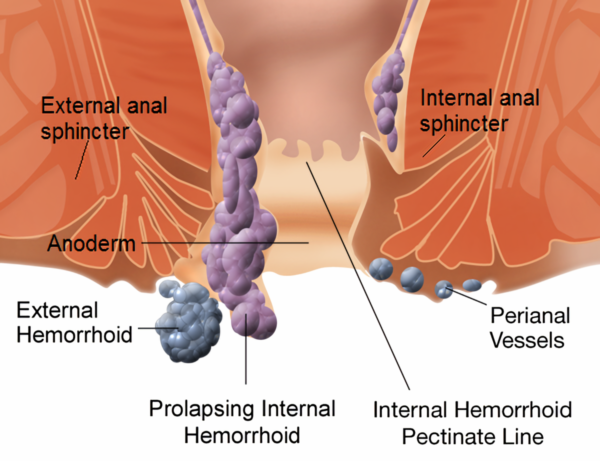 hemorrhoids-piles-image-3-600x46