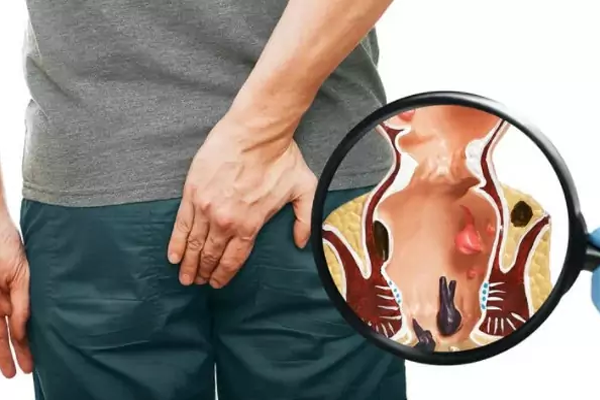 hemorrhoids-piles-image-4 (1)