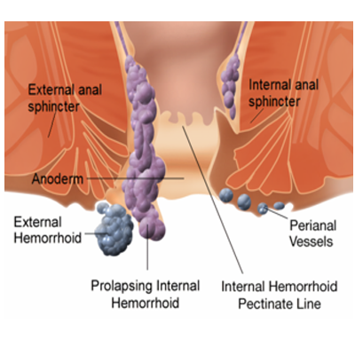 hemorrhoids-piles-service-i