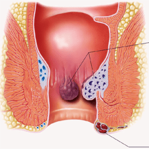 hemorrhoids-services-300x300