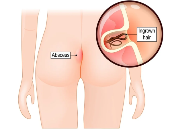pilonidal-sinus-image-1-1-600x45