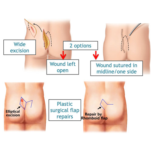 pilonidal-sinus-image-5