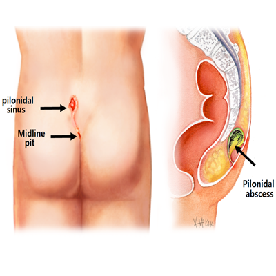 pilonidal-sinus-service-ima