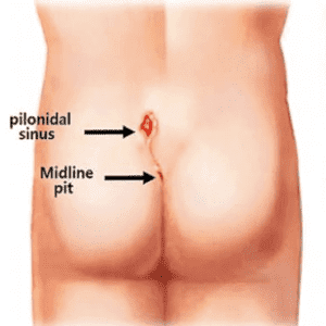 pilonidal-sinus-services-300x300