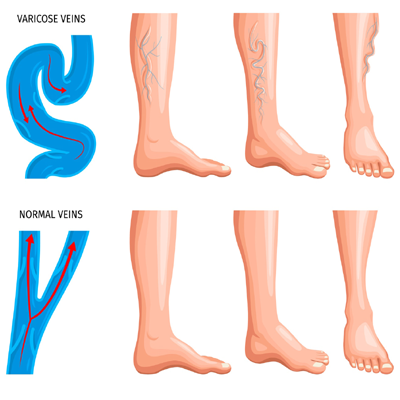 varicose-veins-service-imag