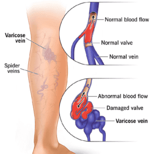 varicose-veins-services-300x300