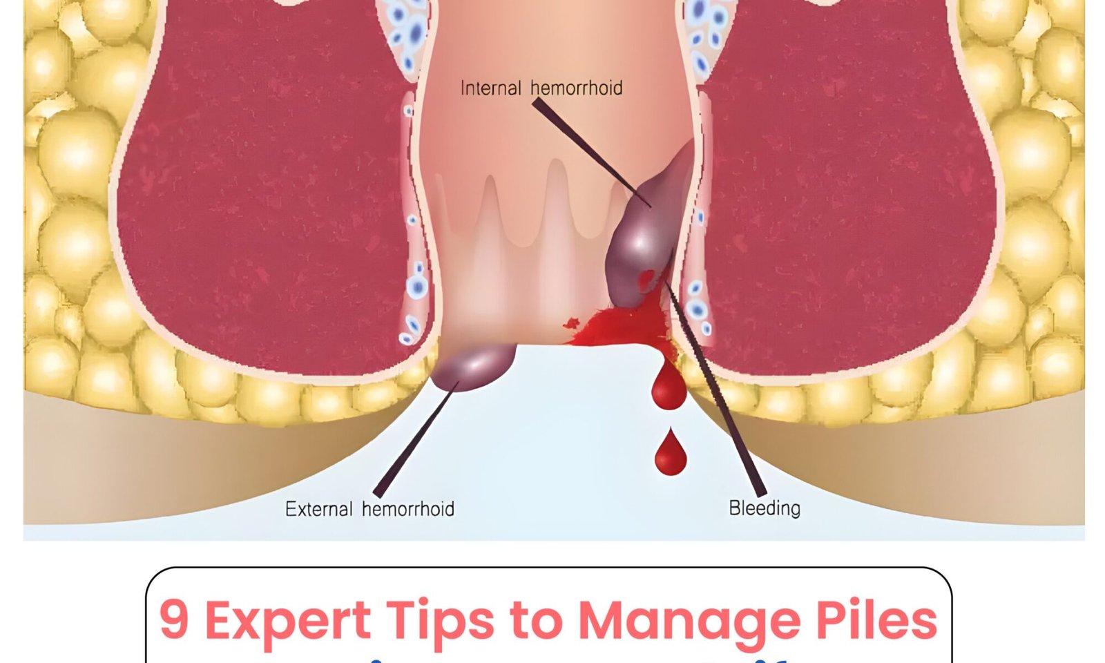 9 Expert Tips to Manage Piles to Live a Normal Life