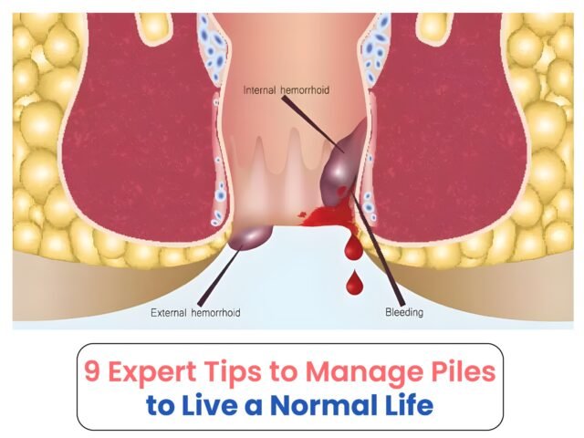 9 Expert Tips to Manage Piles to Live a Normal Life