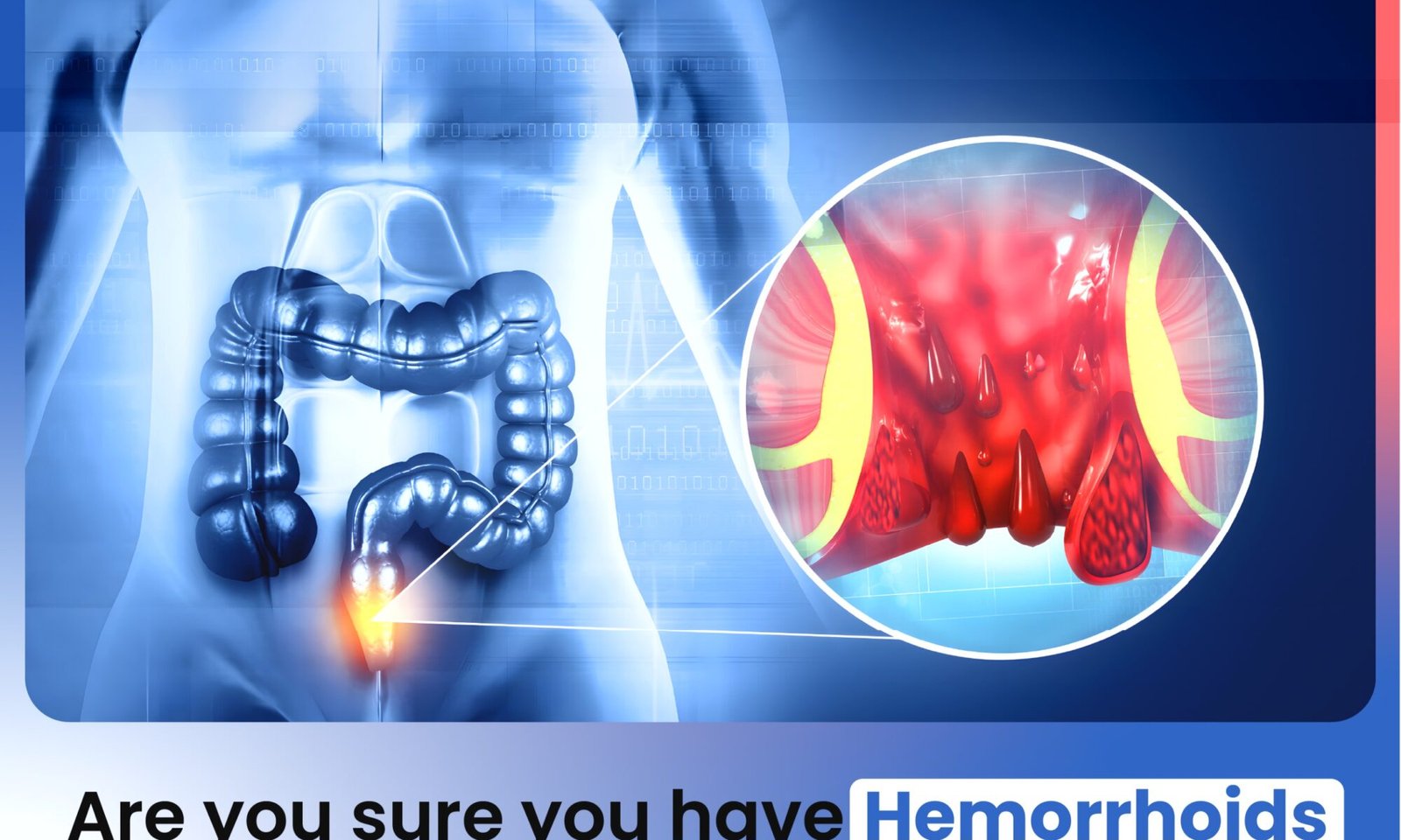 Are you sure you have Hemorrhoids