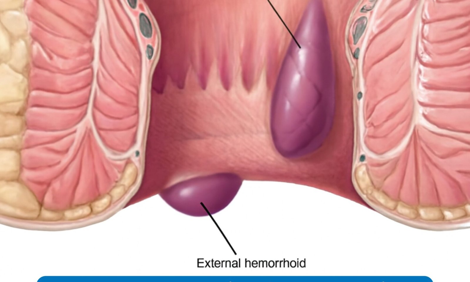 How do you get rid of external piles
