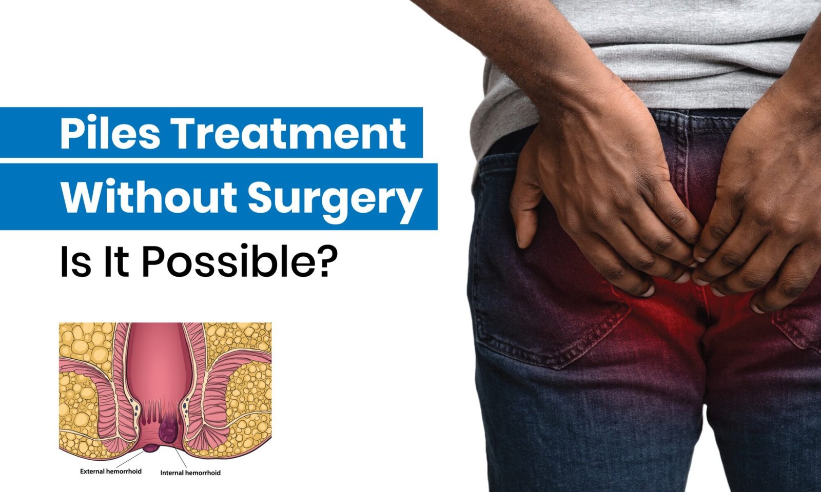 Piles Treatment Without Surgery