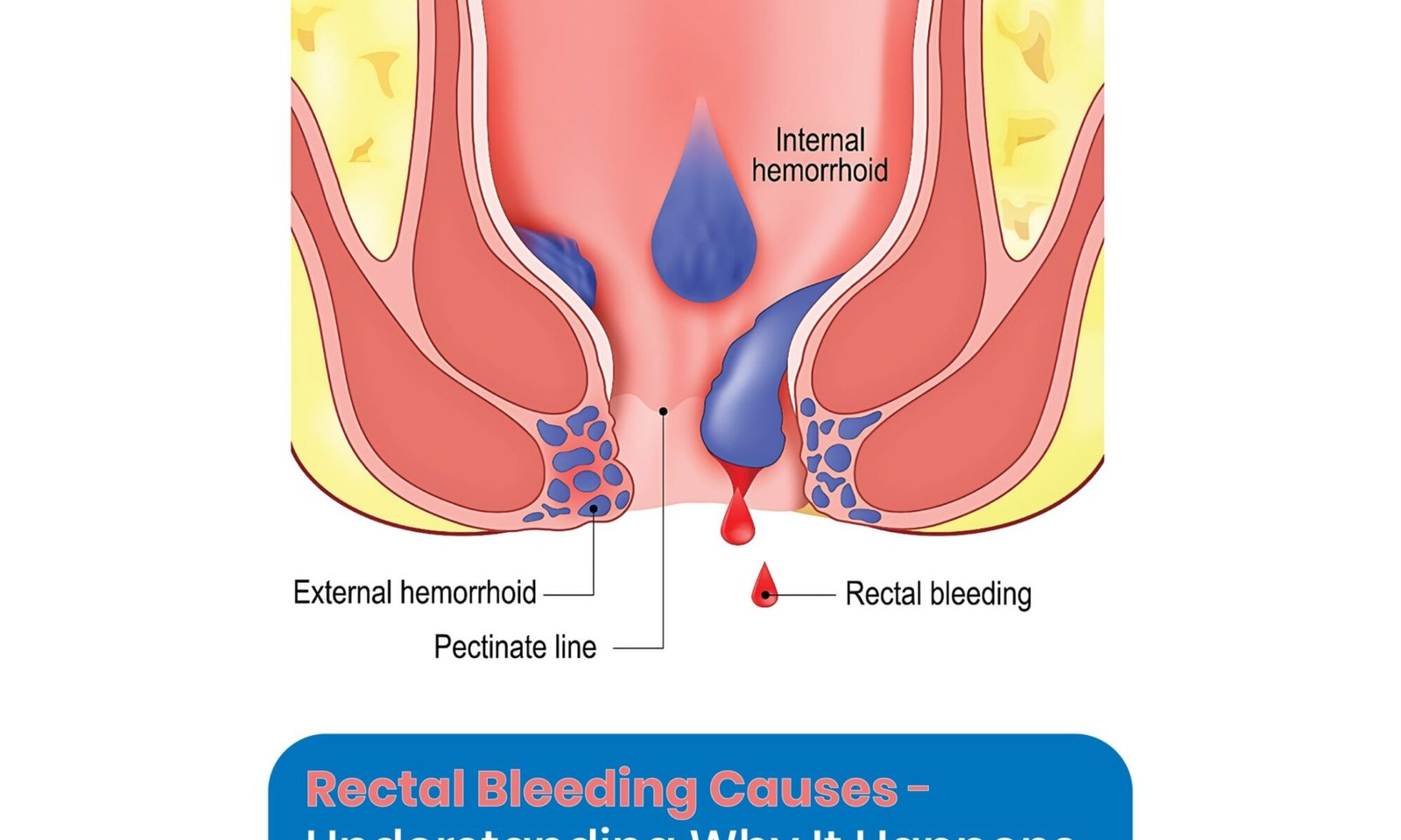 Rectal Bleeding Causes