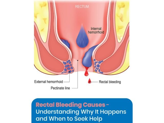 Rectal Bleeding Causes- Understanding Why It Happens and When to Seek Help
