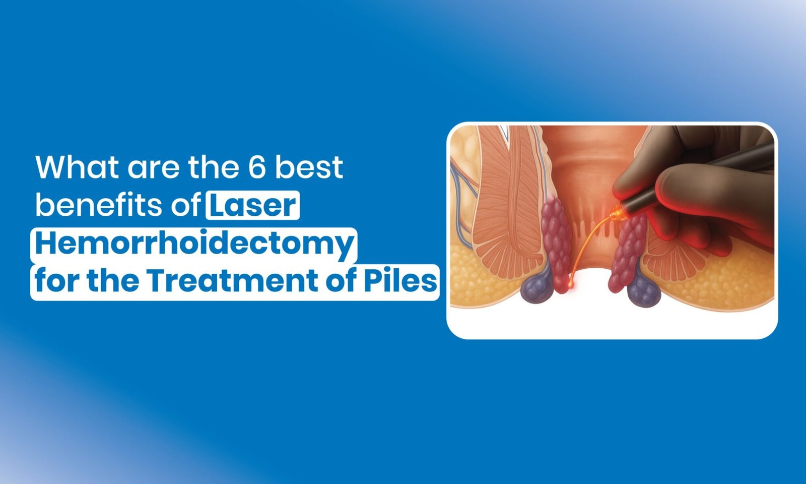 benefits of Laser Hemorrhoidectomy for the Treatment of Piles