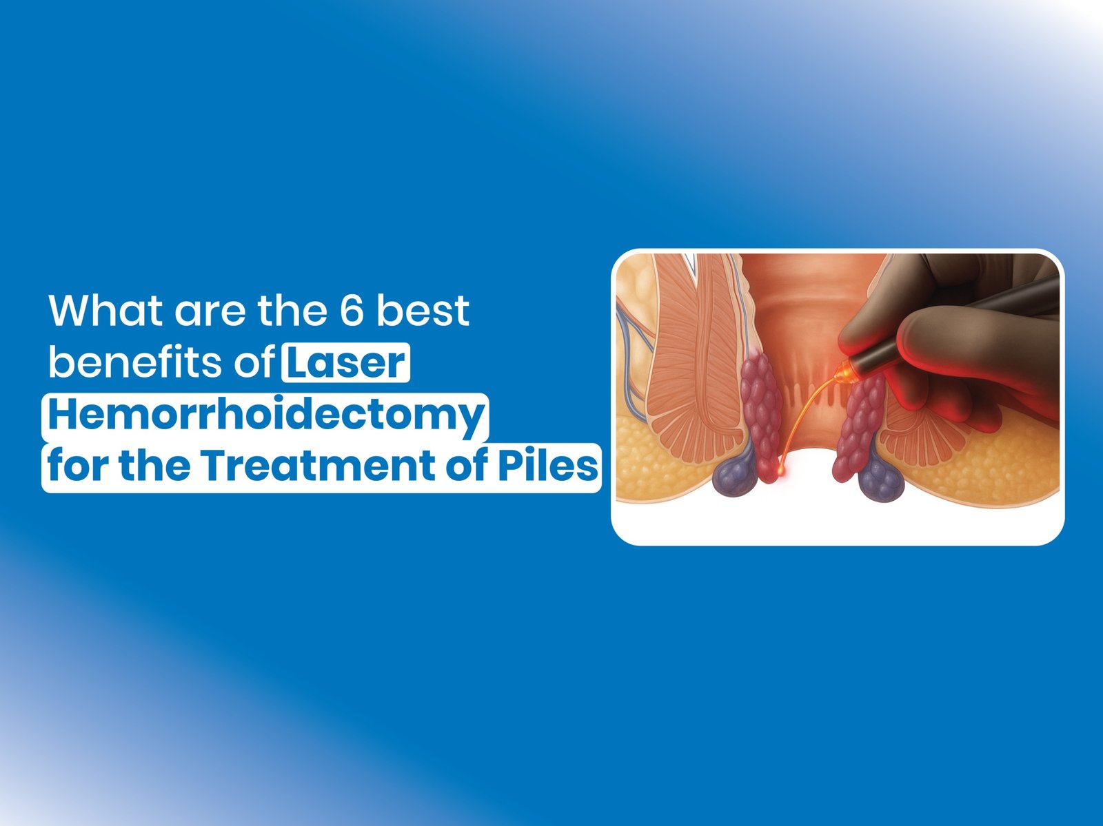 benefits of Laser Hemorrhoidectomy for the Treatment of Piles