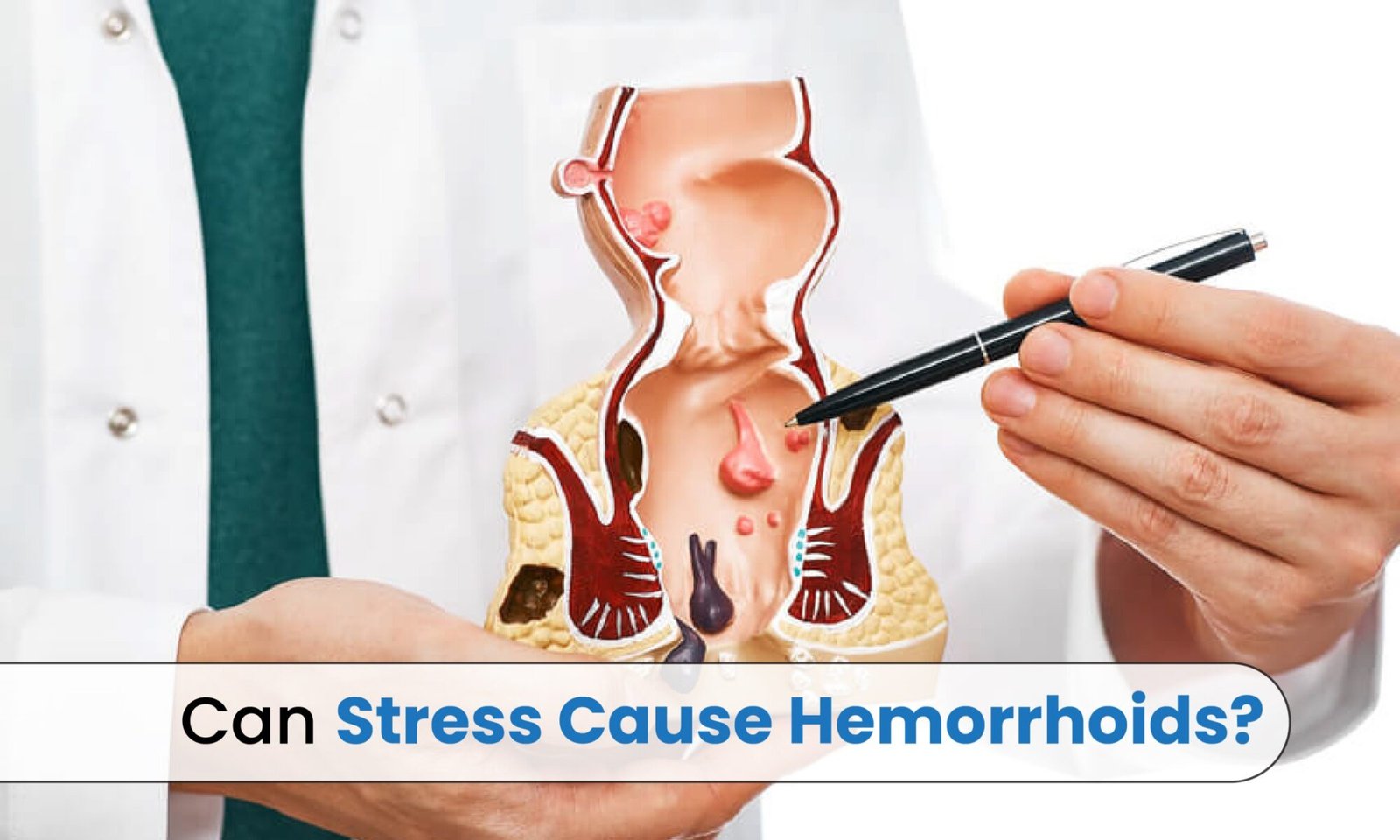 Can Stress Cause Hemorrhoids