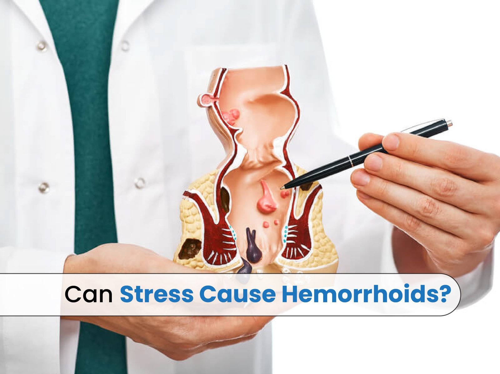 Can Stress Cause Hemorrhoids