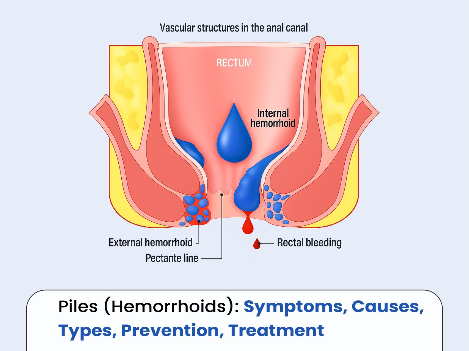 Piles (Hemorrhoids) Symptoms, Causes, Types, Prevention, Treatment