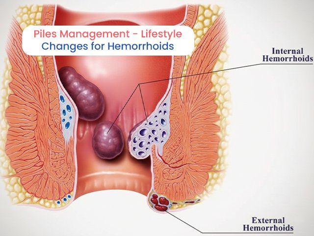 Piles Management - Lifestyle Changes for Hemorrhoids