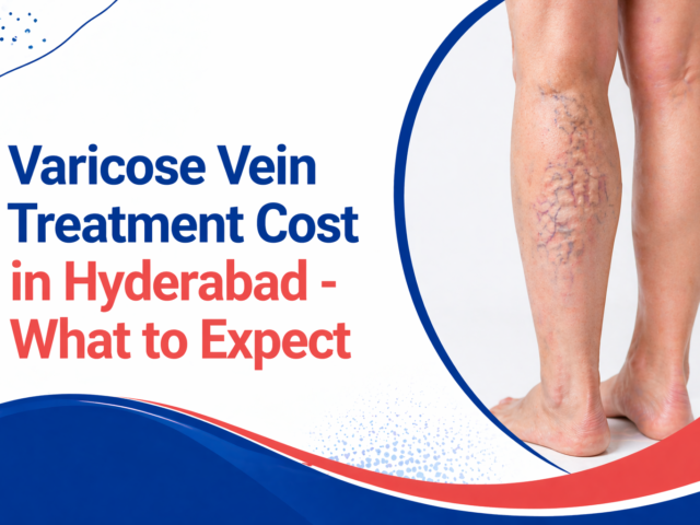 Varicose Vein Treatment Cost in Hyderabad –  What to Expect
