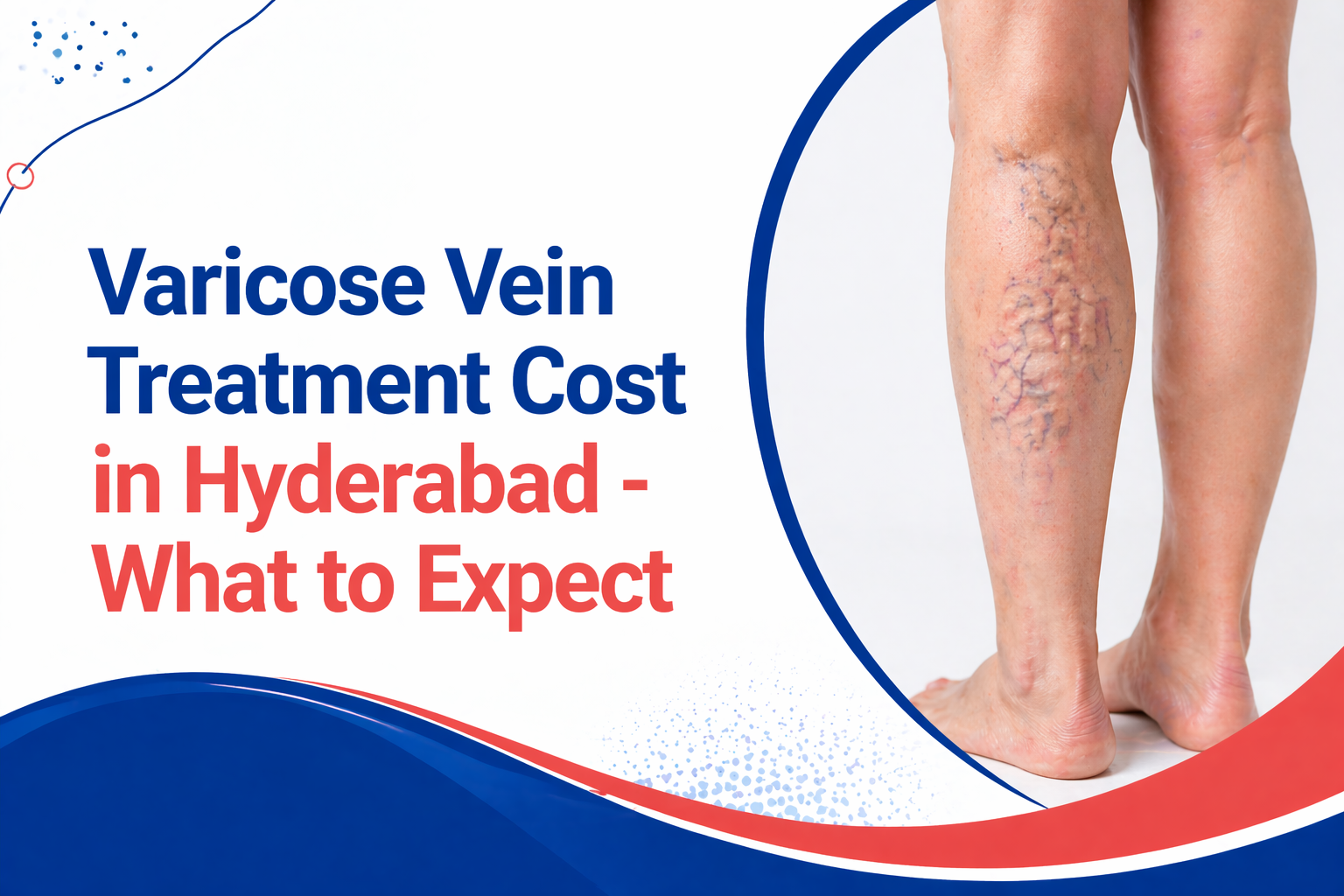 Varicose Vein Treatment Cost in Hyderabad